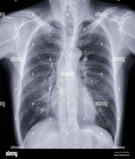 validity of chest x ray result|2015 Screening Chest X.